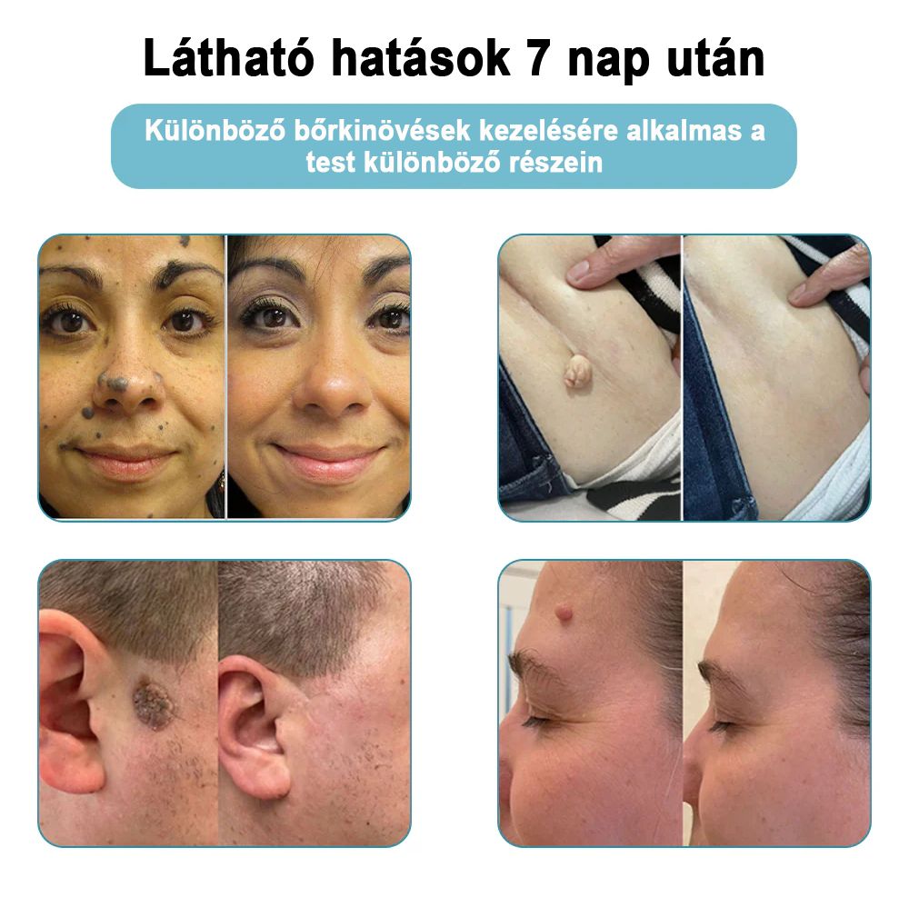 ✨ Bikenda®  – Laserowy Długopis CO₂ do Usuwania 🟤 Znamion, 🦠 Brodawek, 🔘 Przebarwień i Innych Niedoskonałości Skóry)🧿