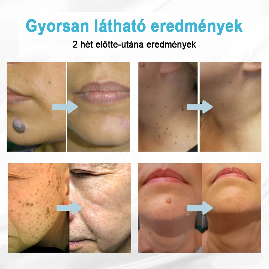 ✨ Bikenda®  – Laserowy Długopis CO₂ do Usuwania 🟤 Znamion, 🦠 Brodawek, 🔘 Przebarwień i Innych Niedoskonałości Skóry)🧿