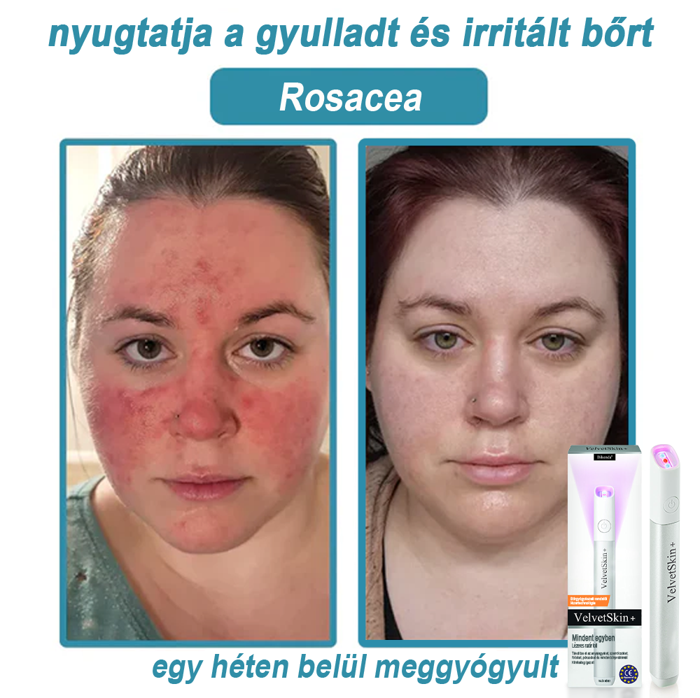 ✨ Bikenda®  – Laserowy Długopis CO₂ do Usuwania 🟤 Znamion, 🦠 Brodawek, 🔘 Przebarwień i Innych Niedoskonałości Skóry)🧿