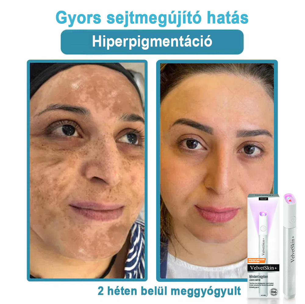 ✨ Bikenda®  – Laserowy Długopis CO₂ do Usuwania 🟤 Znamion, 🦠 Brodawek, 🔘 Przebarwień i Innych Niedoskonałości Skóry)🧿