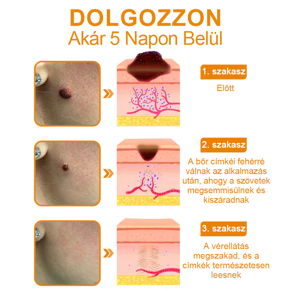 🍯👑BENETURE™ méhméreg szemölcs és anyajegy eltávolító krém (Utolsó napi akció, 80% kedvezmény)