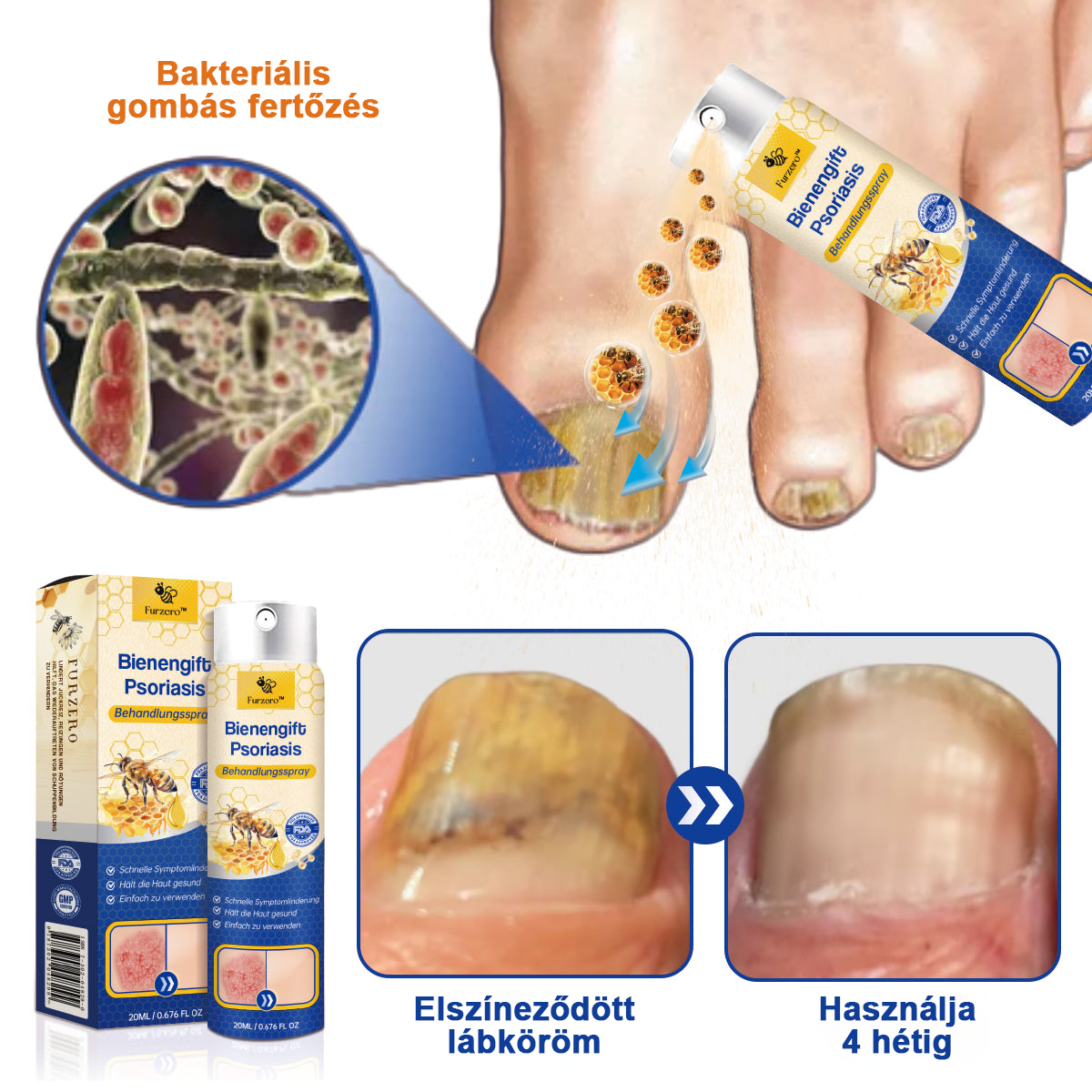 đšââFurzeroâą Psoriasis Treatment Spray-t a viszketĂ©s Ă©s a gyulladĂĄs csökkentĂ©se Ă©rdekĂ©ben 2 hĂ©t utĂĄn. (Dr. KĂĄrolyi Krisztina: hiteles ajĂĄnlĂĄs)