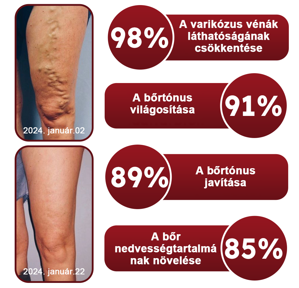 🏥 Furzero™ Pióca visszérkrém (az SSDV Skin Institute által ajánlott)