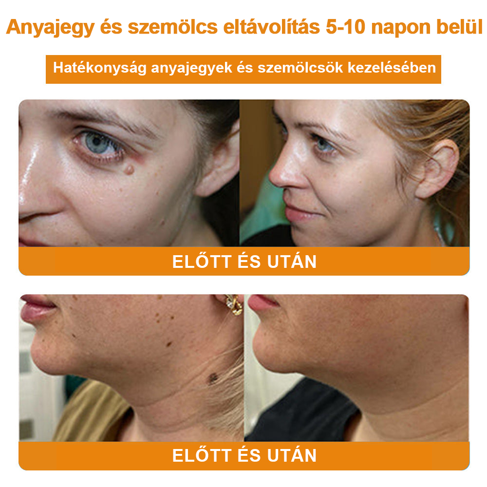 🍯👑BENETURE™ méhméreg szemölcs és anyajegy eltávolító krém (Utolsó napi akció, 80% kedvezmény)