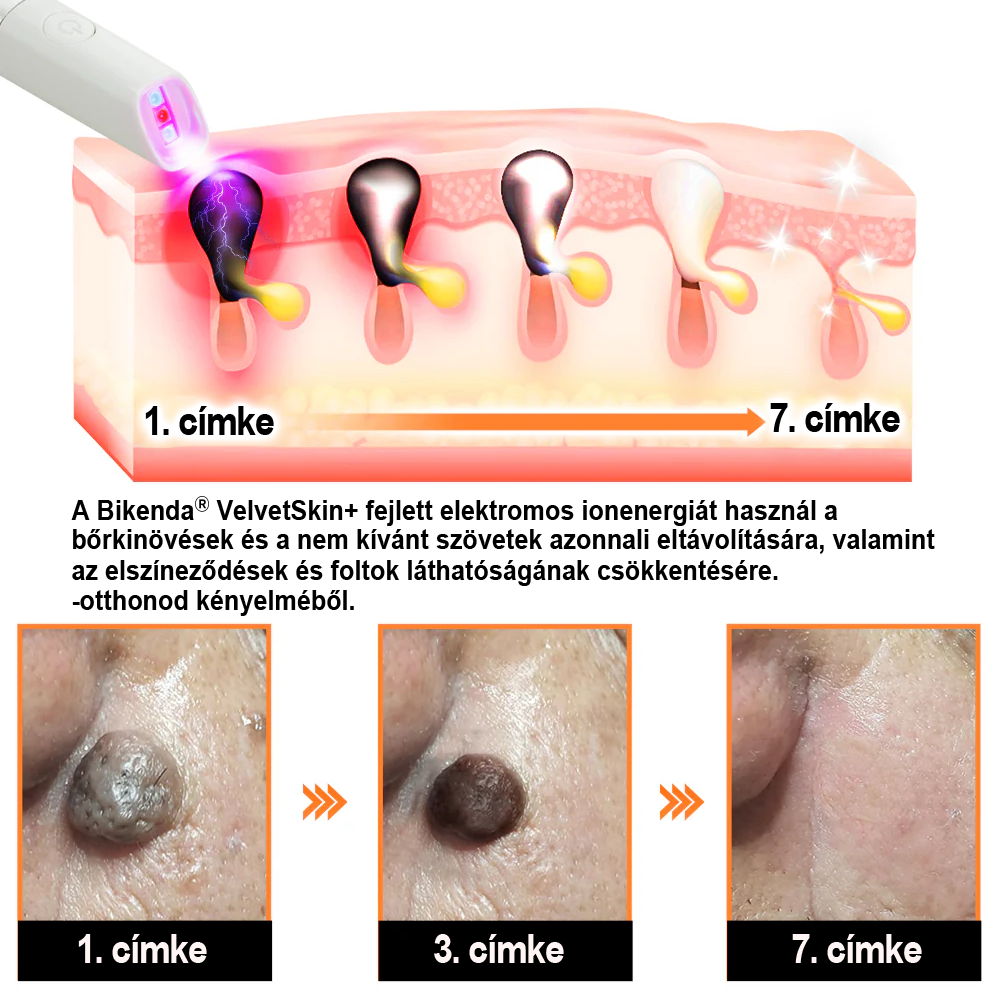 ✨ Bikenda®  – Laserowy Długopis CO₂ do Usuwania 🟤 Znamion, 🦠 Brodawek, 🔘 Przebarwień i Innych Niedoskonałości Skóry)🧿