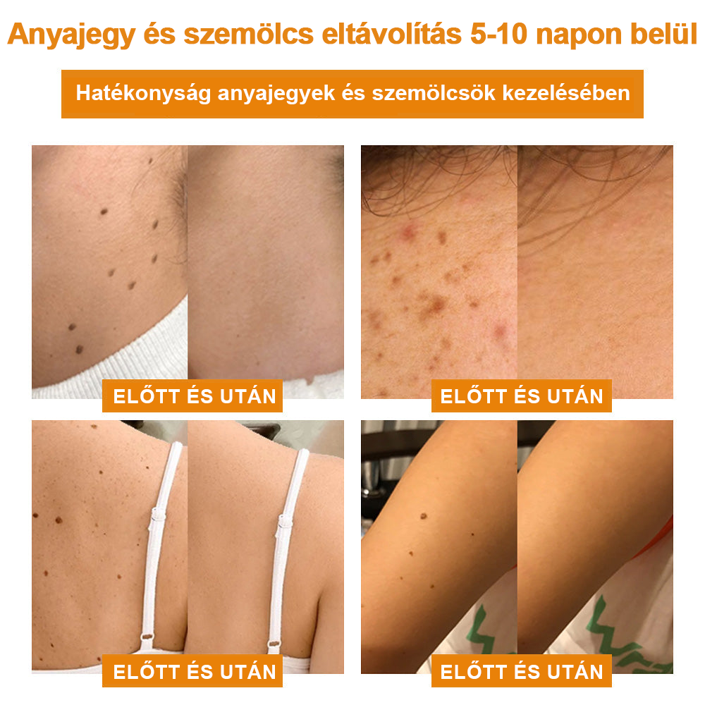 🍯👑BENETURE™ méhméreg szemölcs és anyajegy eltávolító krém (Utolsó napi akció, 80% kedvezmény)