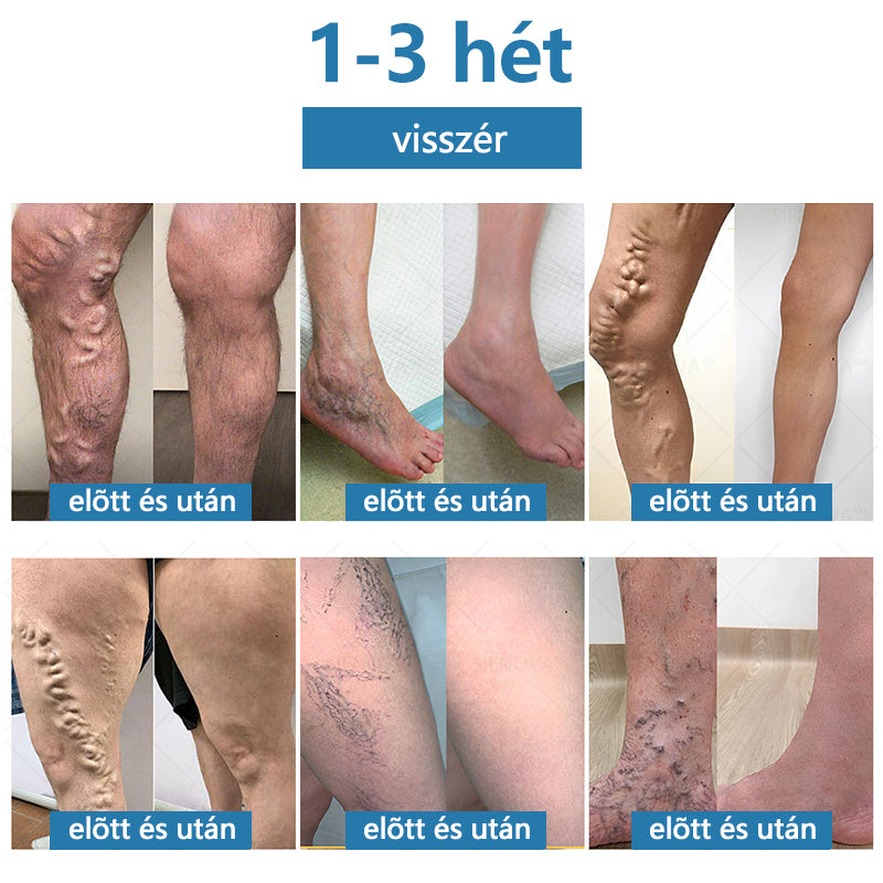 SIENOVA™💎 Hordozható nyirokeltető és ízületi relaxációs készülék👨⚕️ Eredeti 2 az 1-ben terápia | OGYEI minősített