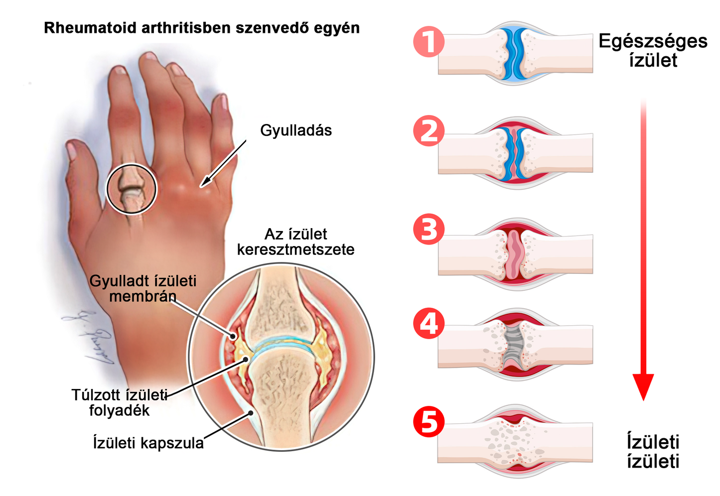 LOVILDS™ méhméreg és kurkuma ízületi gyulladás terápiás krém (👩🔬Ortopédiai betegségekre és ízületi fájdalmakra specializálódott👩🔬)