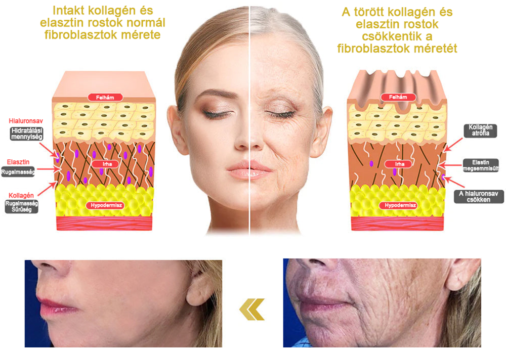 đđ„łFlysmusâą rĂĄnctalanĂtĂł krĂ©m, kreppelĂ©s Ă©s megereszkedĂ©s (đ„74% kedvezmĂ©ny korlĂĄtozott ideig!)