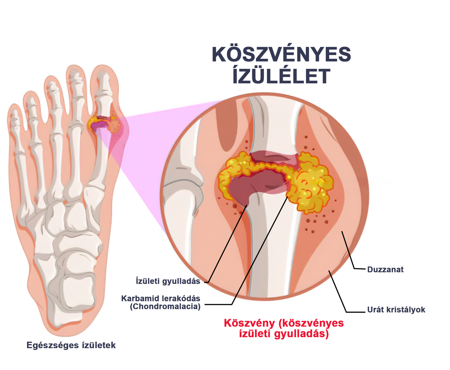 LOVILDS™ méhméreg és kurkuma ízületi gyulladás terápiás krém (👩🔬Ortopédiai betegségekre és ízületi fájdalmakra specializálódott👩🔬)