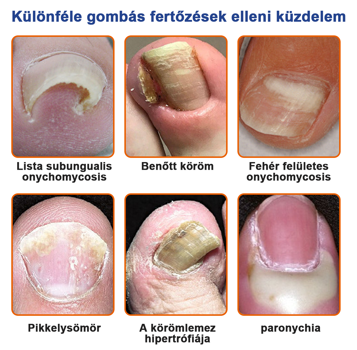 🐝🐝Furzero™ méhméreg körömgomba kezelési megoldás:Teljesen megoldja a körömgomba problémát🌟👣