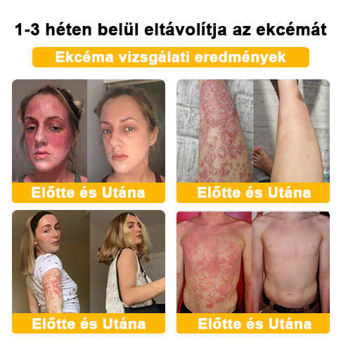 đ©ââïžđZoencgzâą mĂ©hmĂ©reg pikkelysömör eltĂĄvolĂtĂł krĂ©mđ„ (Az SSDV Skin Institute ajĂĄnlĂĄsa)