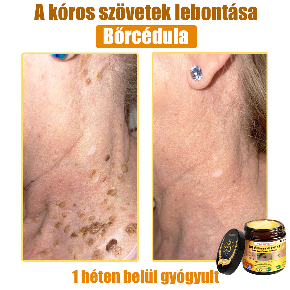Semmelweis Egyetem által ajánlott | Hivatalos bolt | PLTOWE™ teljes testfelületet ápoló krém: öregedésgátló, hidratáló, bőrjavító, egységes bőrtónus, akne- és sötét folt kezelés, szemölcs- és anyajegy eltávolítás, pikkelysömör enyhítése