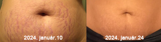 🏥 Furzero™ Pióca visszérkrém (az SSDV Skin Institute által ajánlott)