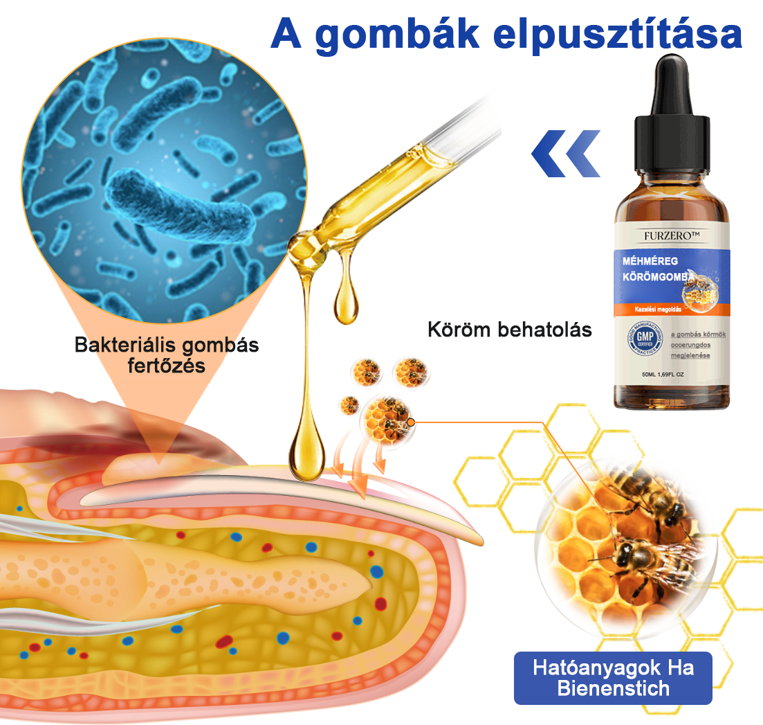 🐝🐝Furzero™ méhméreg körömgomba kezelési megoldás:Teljesen megoldja a körömgomba problémát🌟👣