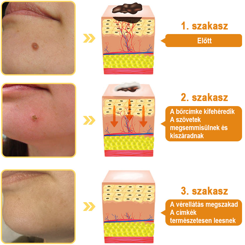 đđMĂ©hmĂ©reg szemölcs Ă©s övsömör eltĂĄvolĂtĂł spray (đšââAAD AjĂĄnlott) đ„(đ„Last Day 80% Off)