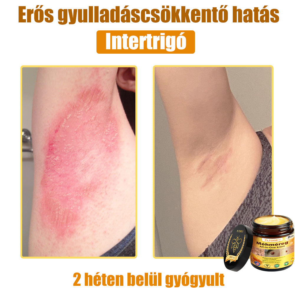 Semmelweis Egyetem által ajánlott | Hivatalos bolt | PLTOWE™ teljes testfelületet ápoló krém: öregedésgátló, hidratáló, bőrjavító, egységes bőrtónus, akne- és sötét folt kezelés, szemölcs- és anyajegy eltávolítás, pikkelysömör enyhítése