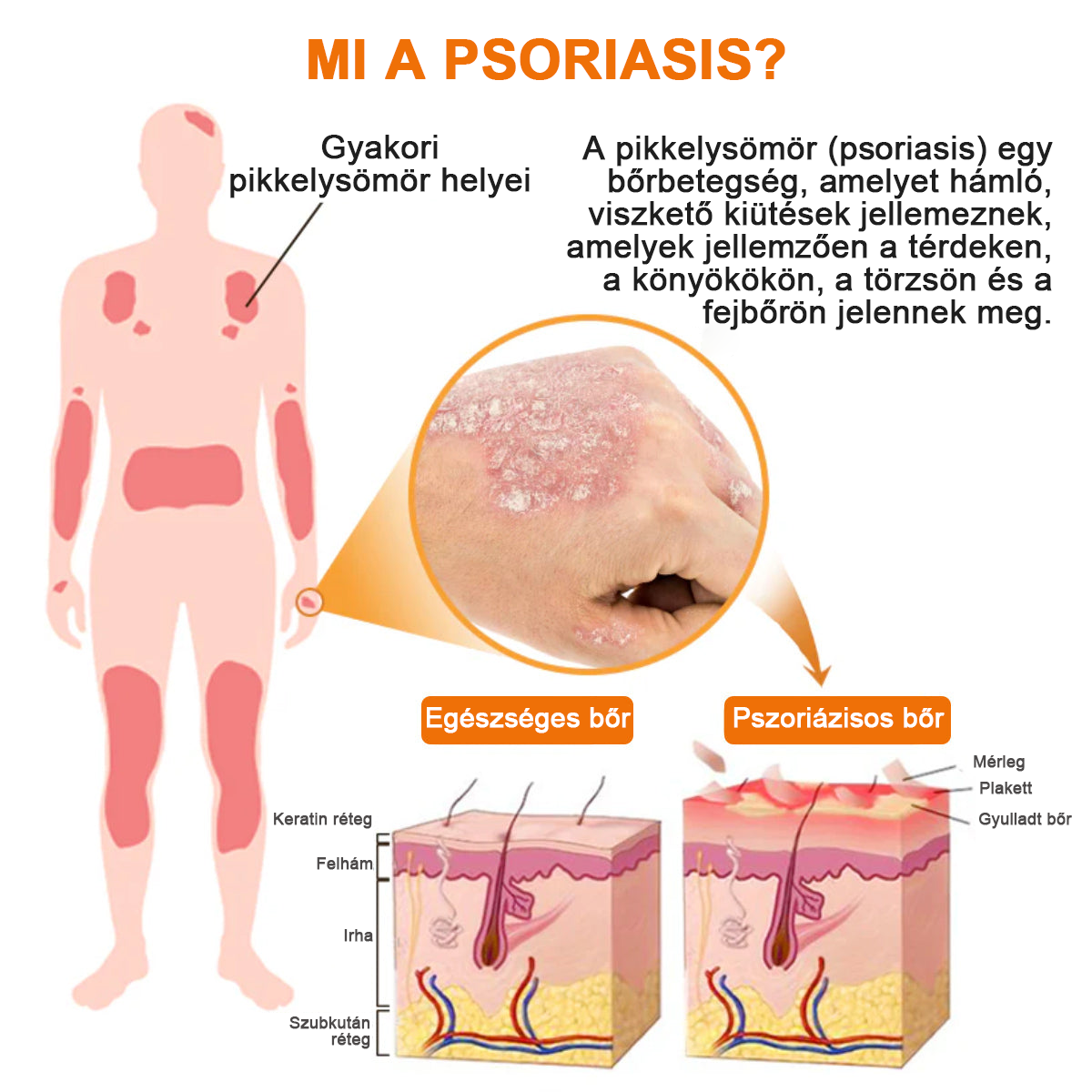 đšââFurzeroâą Psoriasis Treatment Spray-t a viszketĂ©s Ă©s a gyulladĂĄs csökkentĂ©se Ă©rdekĂ©ben 2 hĂ©t utĂĄn. (Dr. KĂĄrolyi Krisztina: hiteles ajĂĄnlĂĄs)