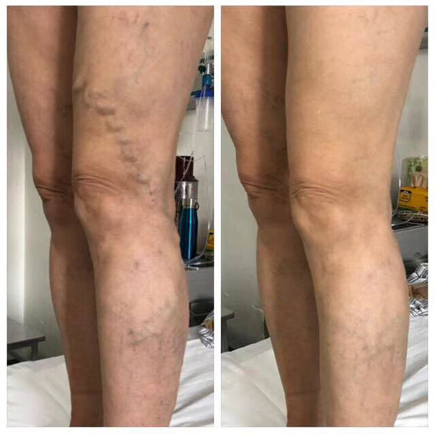 🏥 Furzero™ Pióca visszérkrém (az SSDV Skin Institute által ajánlott)
