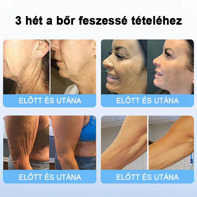 đđ„łFlysmusâą rĂĄnctalanĂtĂł krĂ©m, kreppelĂ©s Ă©s megereszkedĂ©s (đ„74% kedvezmĂ©ny korlĂĄtozott ideig!)