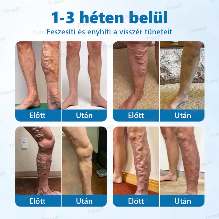 🌿🌿Trimil® VeinGuard Gyógynövényes Spray - ✅ Klinikailag bizonyított, hogy mindössze 7 nap alatt megszünteti a visszereket!