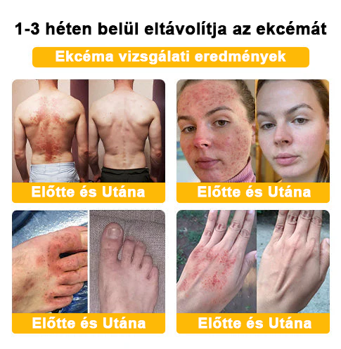 đ©ââïžđZoencgzâą mĂ©hmĂ©reg pikkelysömör eltĂĄvolĂtĂł krĂ©mđ„ (Az SSDV Skin Institute ajĂĄnlĂĄsa)