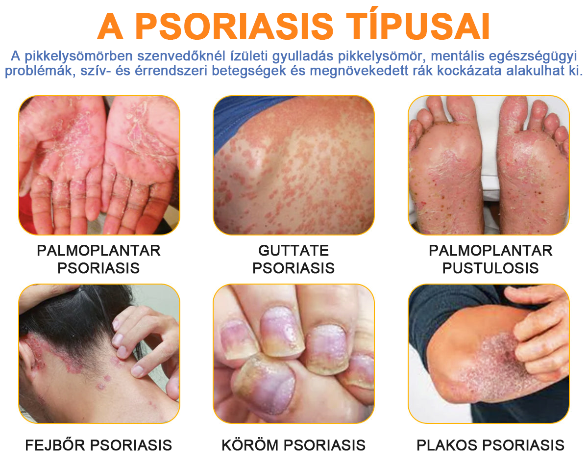 đšââFurzeroâą Psoriasis Treatment Spray-t a viszketĂ©s Ă©s a gyulladĂĄs csökkentĂ©se Ă©rdekĂ©ben 2 hĂ©t utĂĄn. (Dr. KĂĄrolyi Krisztina: hiteles ajĂĄnlĂĄs)