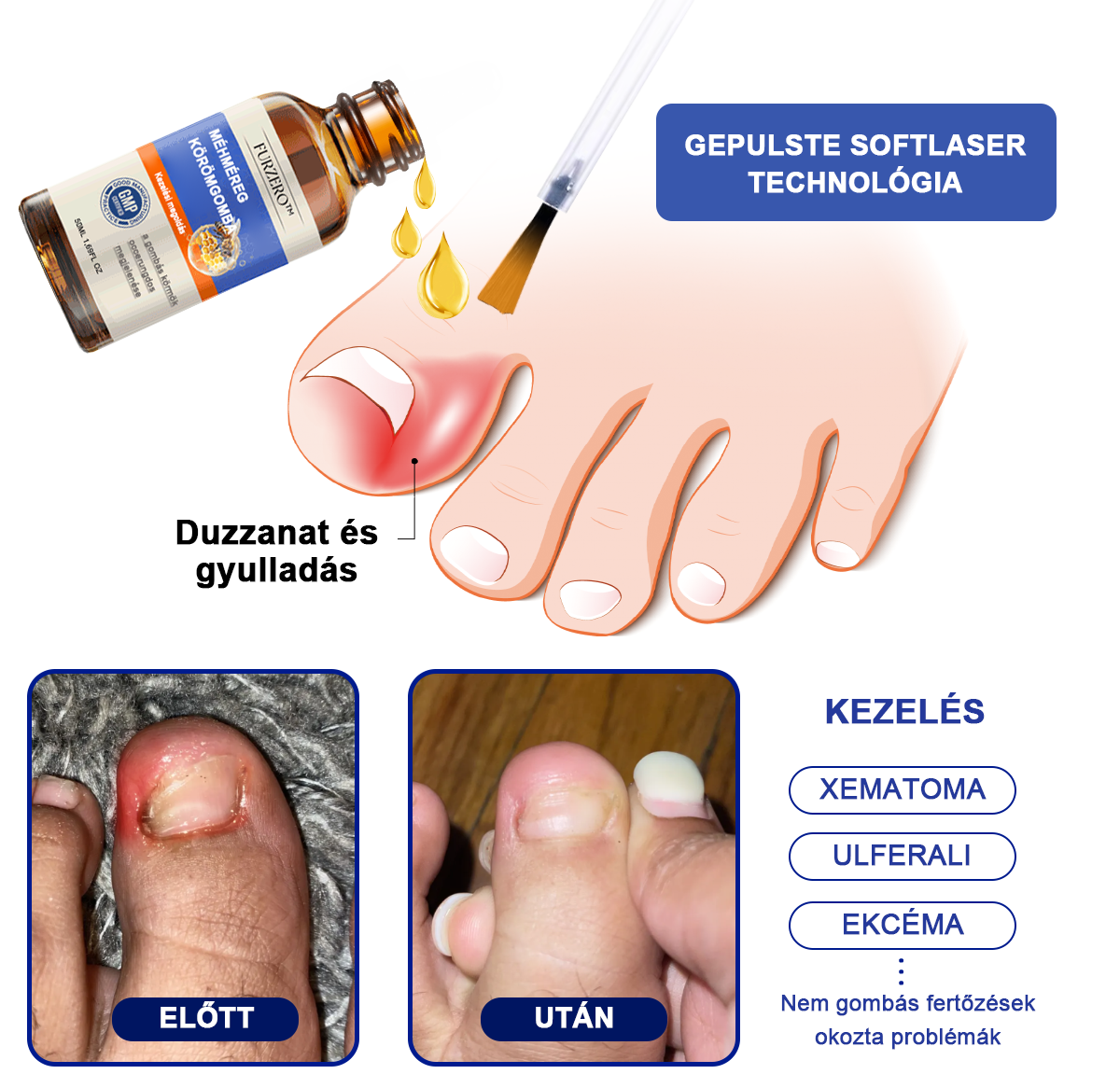 🐝🐝Furzero™ méhméreg körömgomba kezelési megoldás:Teljesen megoldja a körömgomba problémát🌟👣
