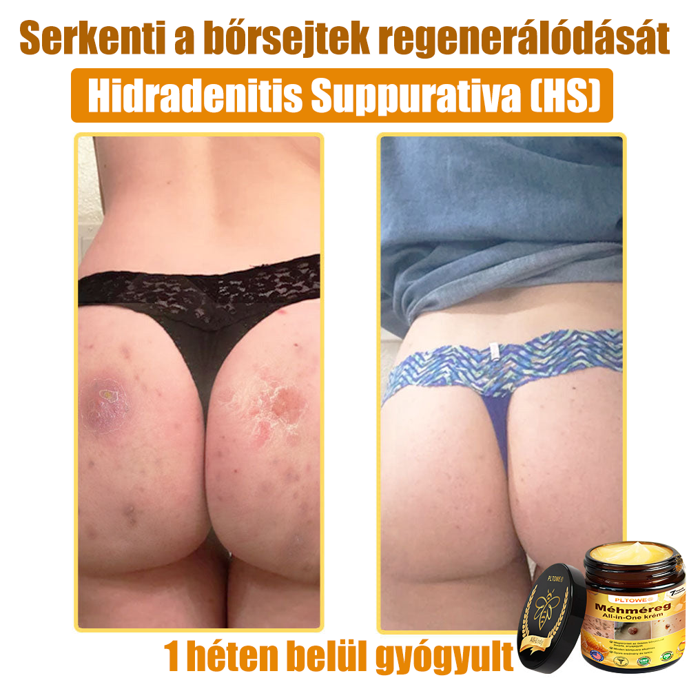 Semmelweis Egyetem által ajánlott | Hivatalos bolt | PLTOWE™ teljes testfelületet ápoló krém: öregedésgátló, hidratáló, bőrjavító, egységes bőrtónus, akne- és sötét folt kezelés, szemölcs- és anyajegy eltávolítás, pikkelysömör enyhítése