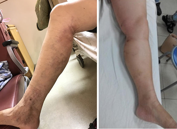🏥 Furzero™ Pióca visszérkrém (az SSDV Skin Institute által ajánlott)