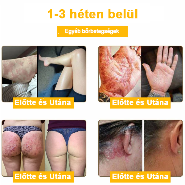 đ©ââïžđZoencgzâą mĂ©hmĂ©reg pikkelysömör eltĂĄvolĂtĂł krĂ©mđ„ (Az SSDV Skin Institute ajĂĄnlĂĄsa)