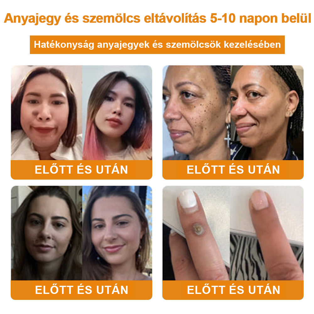 🍯👑BENETURE™ méhméreg szemölcs és anyajegy eltávolító krém (Utolsó napi akció, 80% kedvezmény)