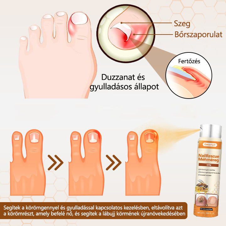 2025🎁 Korlátozott idejű akció 70% kedvezménnyel ️️⏳ Ceoerty® körömgomba spray méhméreggel 💥 2 hét alatt megoldja az összes körömproblémát