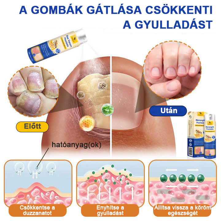 đšââFurzeroâą Psoriasis Treatment Spray-t a viszketĂ©s Ă©s a gyulladĂĄs csökkentĂ©se Ă©rdekĂ©ben 2 hĂ©t utĂĄn. (Dr. KĂĄrolyi Krisztina: hiteles ajĂĄnlĂĄs)