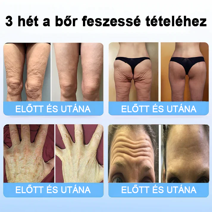 đđ„łFlysmusâą rĂĄnctalanĂtĂł krĂ©m, kreppelĂ©s Ă©s megereszkedĂ©s (đ„74% kedvezmĂ©ny korlĂĄtozott ideig!)
