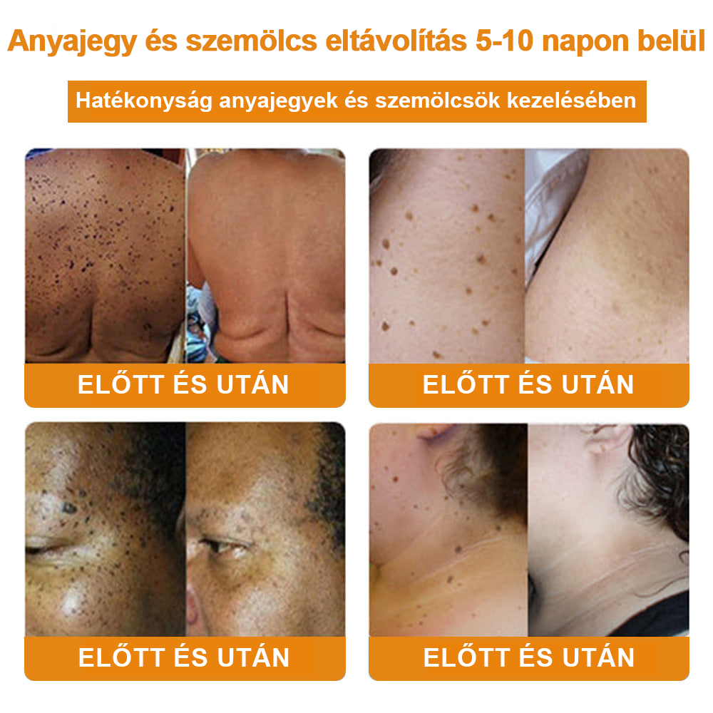 🍯👑BENETURE™ méhméreg szemölcs és anyajegy eltávolító krém (Utolsó napi akció, 80% kedvezmény)