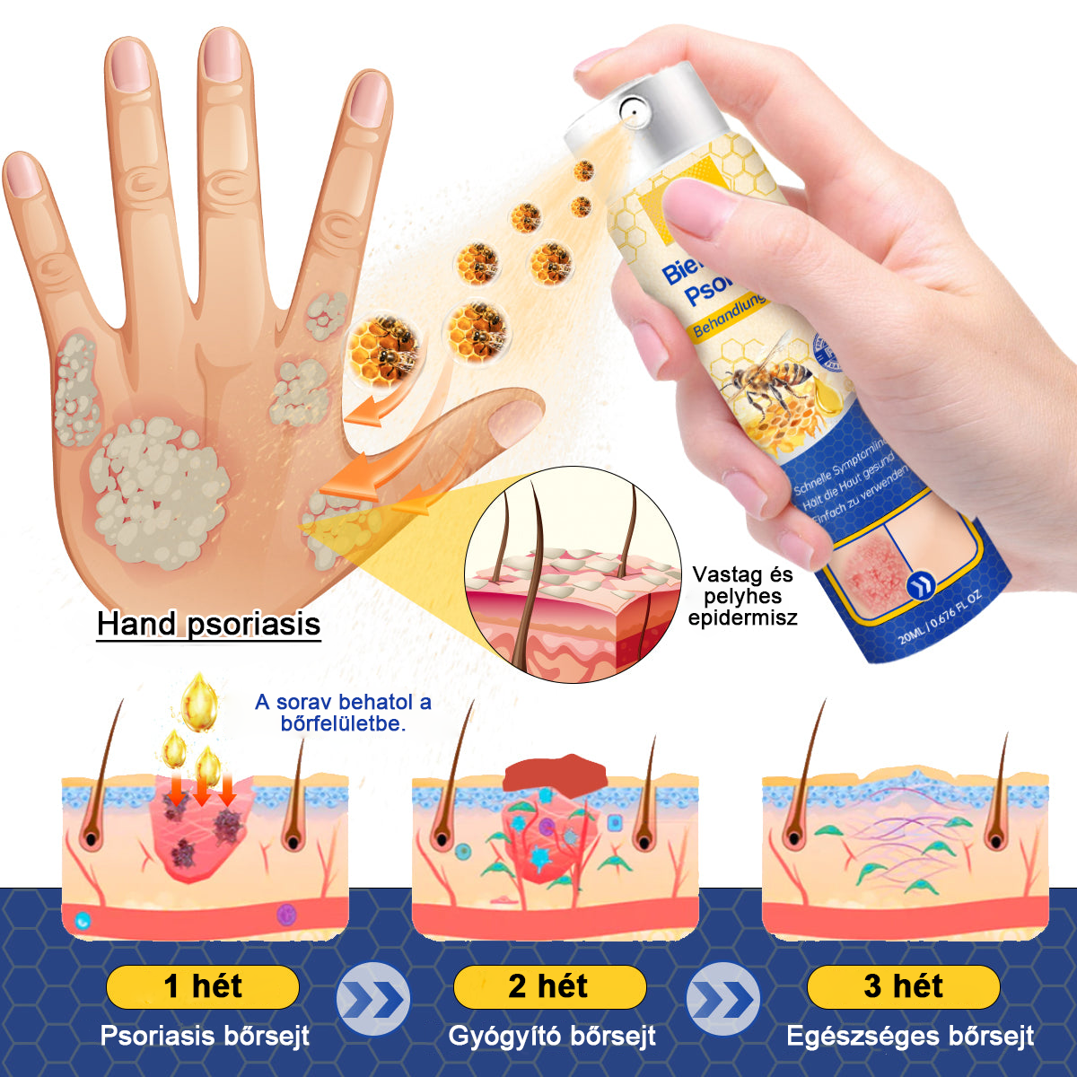 đšââFurzeroâą Psoriasis Treatment Spray-t a viszketĂ©s Ă©s a gyulladĂĄs csökkentĂ©se Ă©rdekĂ©ben 2 hĂ©t utĂĄn. (Dr. KĂĄrolyi Krisztina: hiteles ajĂĄnlĂĄs)