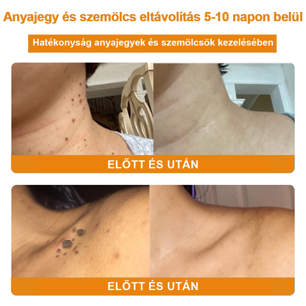 🍯👑BENETURE™ méhméreg szemölcs és anyajegy eltávolító krém (Utolsó napi akció, 80% kedvezmény)