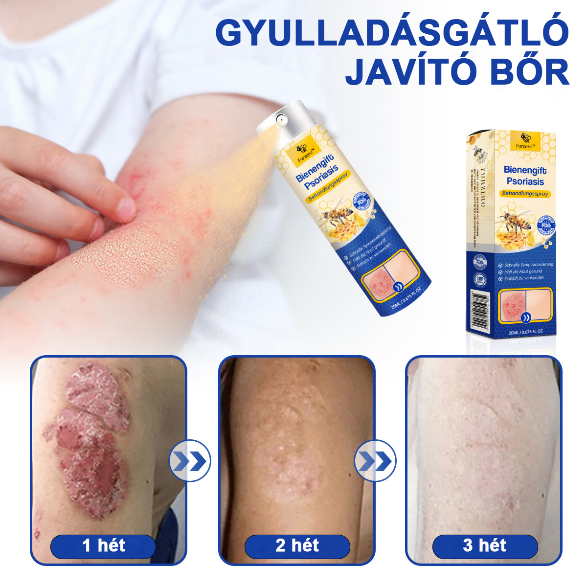 đšââFurzeroâą Psoriasis Treatment Spray-t a viszketĂ©s Ă©s a gyulladĂĄs csökkentĂ©se Ă©rdekĂ©ben 2 hĂ©t utĂĄn. (Dr. KĂĄrolyi Krisztina: hiteles ajĂĄnlĂĄs)