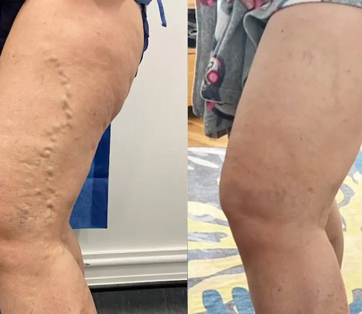 🏥 Furzero™ Pióca visszérkrém (az SSDV Skin Institute által ajánlott)