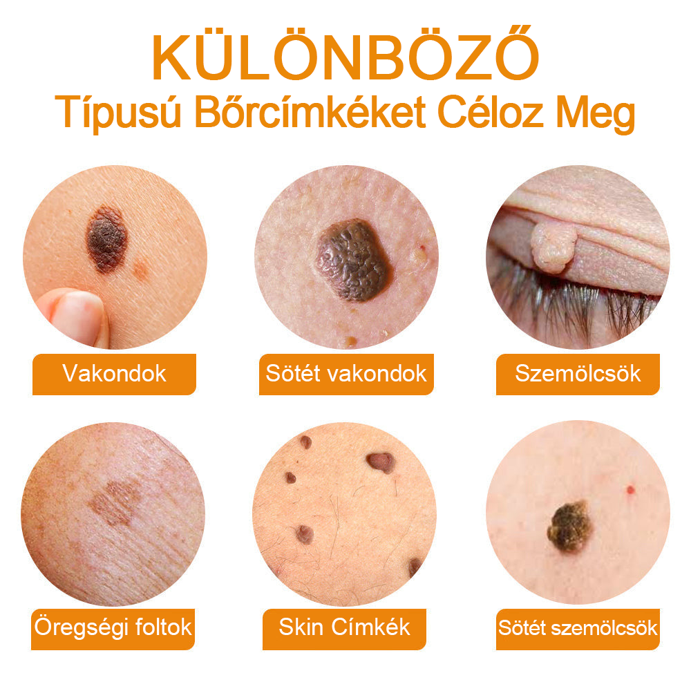 🍯👑BENETURE™ méhméreg szemölcs és anyajegy eltávolító krém (Utolsó napi akció, 80% kedvezmény)