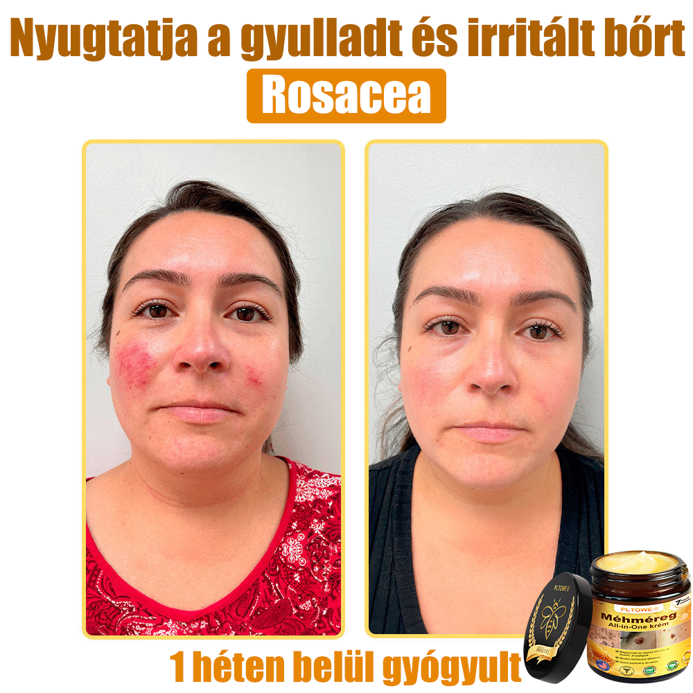 Semmelweis Egyetem által ajánlott | Hivatalos bolt | PLTOWE™ teljes testfelületet ápoló krém: öregedésgátló, hidratáló, bőrjavító, egységes bőrtónus, akne- és sötét folt kezelés, szemölcs- és anyajegy eltávolítás, pikkelysömör enyhítése
