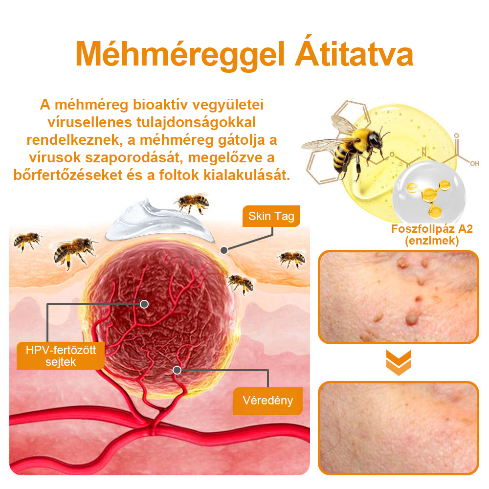 🍯👑BENETURE™ méhméreg szemölcs és anyajegy eltávolító krém (Utolsó napi akció, 80% kedvezmény)