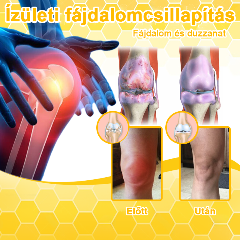 LOVILDS™ méhméreg és kurkuma ízületi gyulladás terápiás krém (👩🔬Ortopédiai betegségekre és ízületi fájdalmakra specializálódott👩🔬)