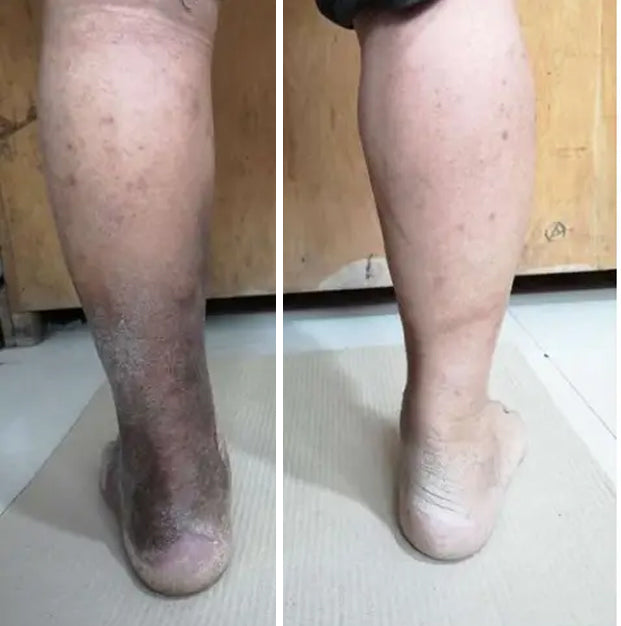 🏥 Furzero™ Pióca visszérkrém (az SSDV Skin Institute által ajánlott)