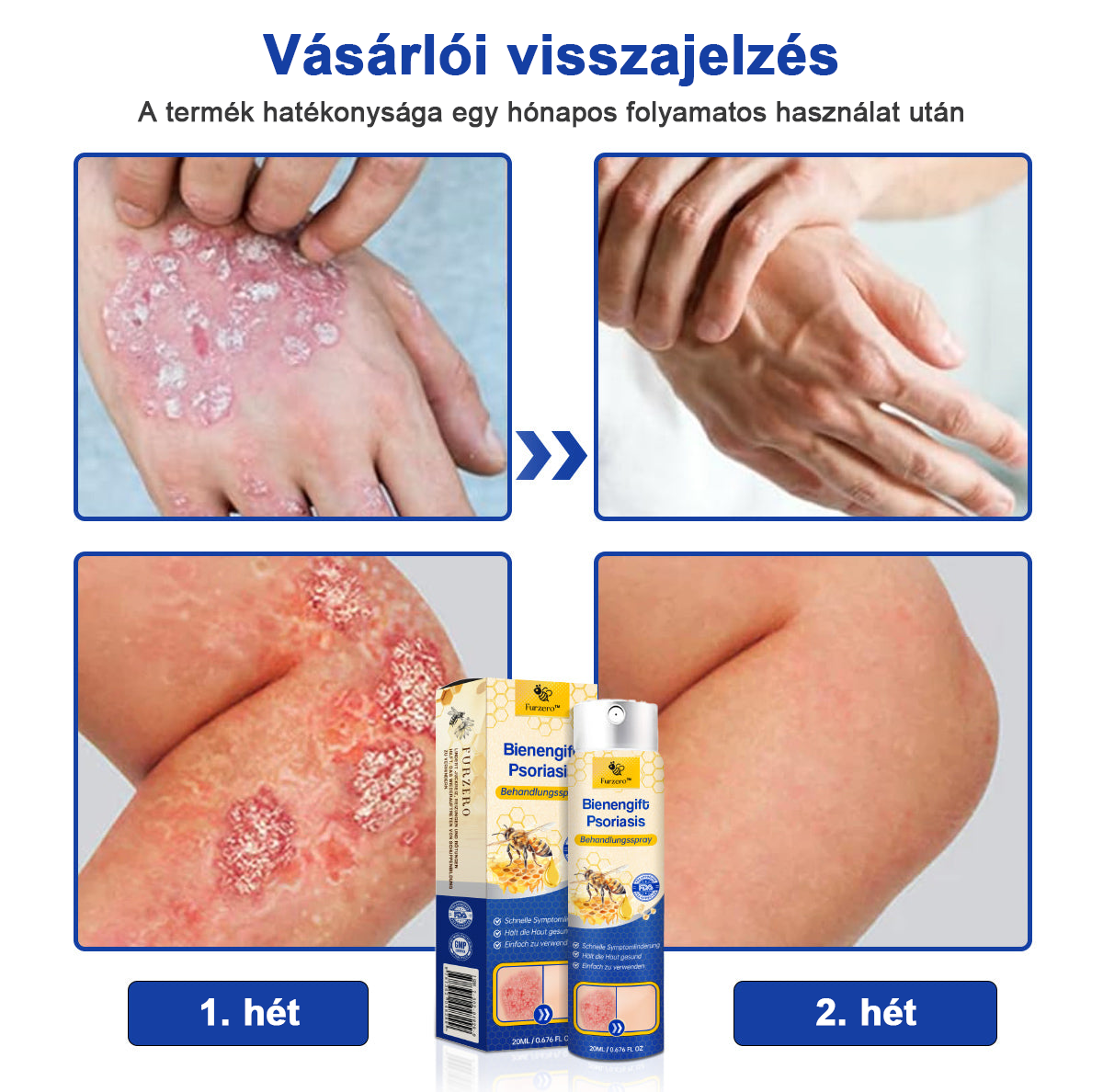 đšââFurzeroâą Psoriasis Treatment Spray-t a viszketĂ©s Ă©s a gyulladĂĄs csökkentĂ©se Ă©rdekĂ©ben 2 hĂ©t utĂĄn. (Dr. KĂĄrolyi Krisztina: hiteles ajĂĄnlĂĄs)
