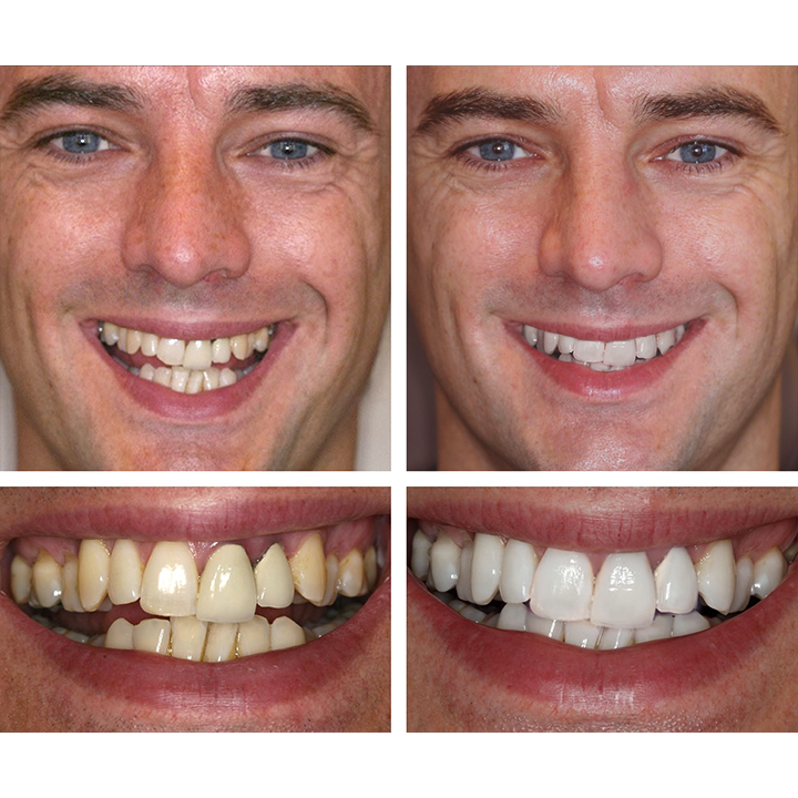 ⏳Limited Time Offer⏳LIMETOW™ Teeth Whitening Essence