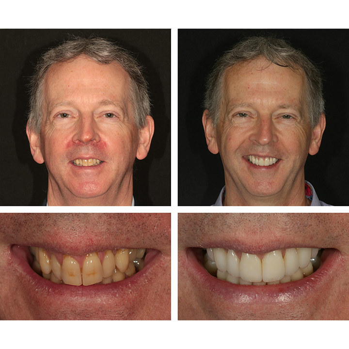 ⏳Limited Time Offer⏳LIMETOW™ Teeth Whitening Essence
