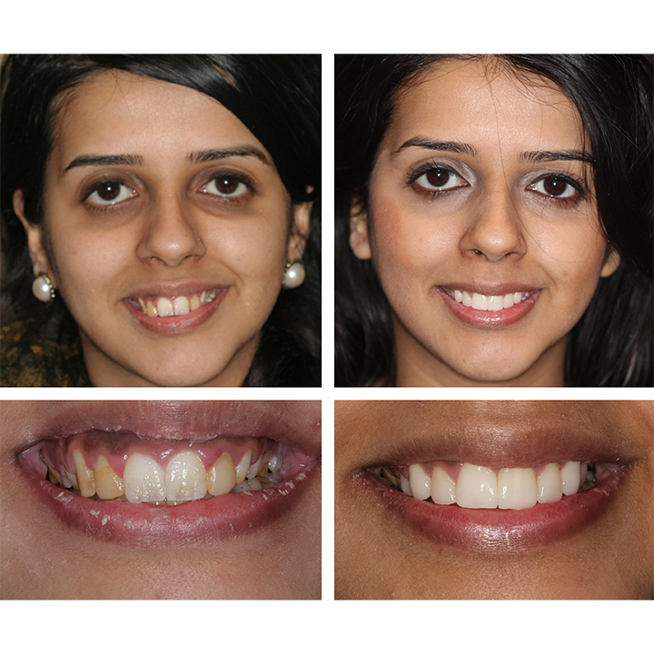 ⏳Limited Time Offer⏳LIMETOW™ Teeth Whitening Essence