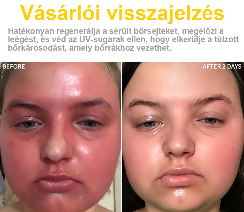 🐝✨𝑩𝑺𝑾𝑬𝑳𝑳® 𝑴é𝒉𝒎é𝒓𝒆𝒈 𝑲𝒆𝒛𝒆𝒍é𝒔 𝑲𝒓é𝒎👨⚕️(𝑫𝒆𝒓𝒎𝒂𝒕𝒐𝒍ó𝒈𝒖𝒔 𝒂𝒋á𝒏𝒍á𝒔𝒐𝒌) (🔥𝒖𝒕𝒐𝒍𝒔ó 𝒏𝒂𝒑 𝒑𝒓𝒐𝒎ó𝒄𝒊ó 80% 𝒌𝒊)